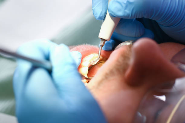 Teeth Whitening in GA