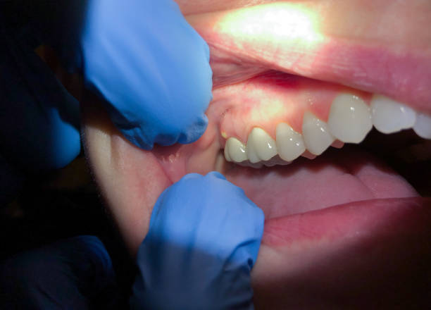 Best Tooth Infection Emergency Dentist  in Austell, GA